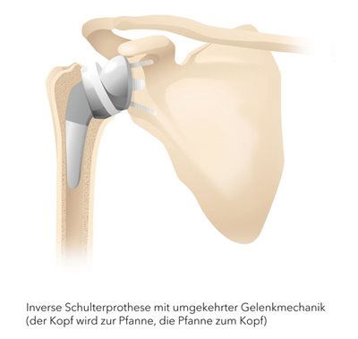 inverse Schulterprothese