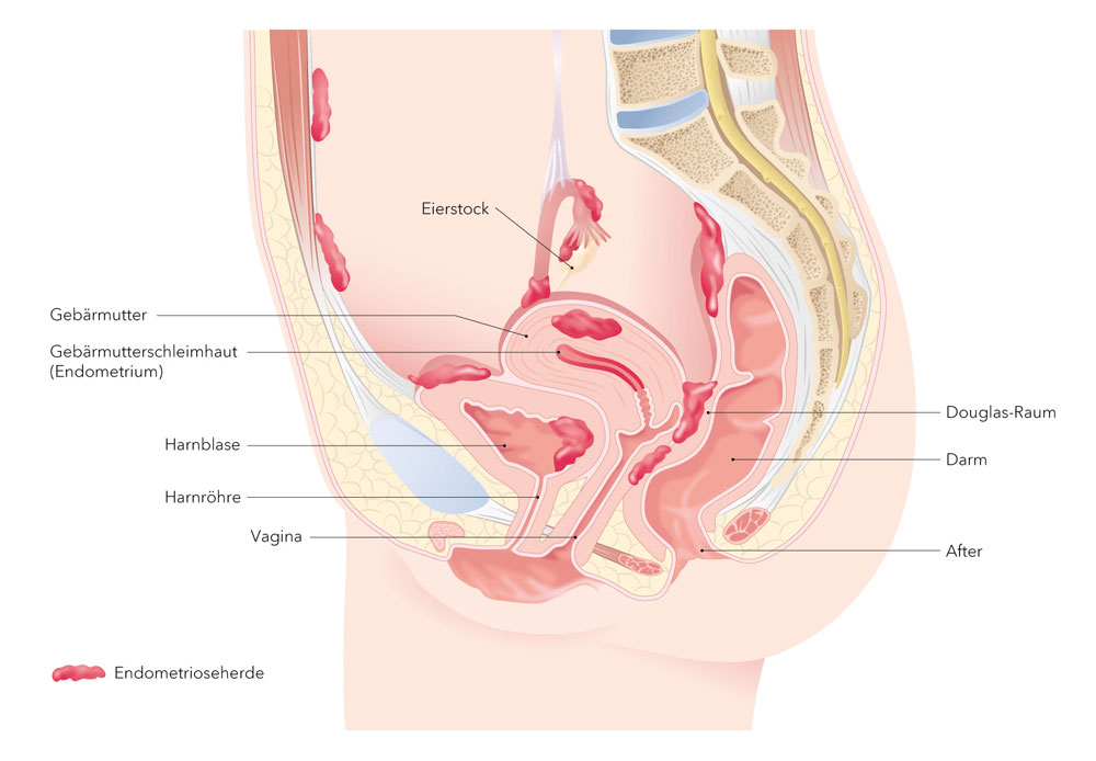 Grafik Endometrioseherde