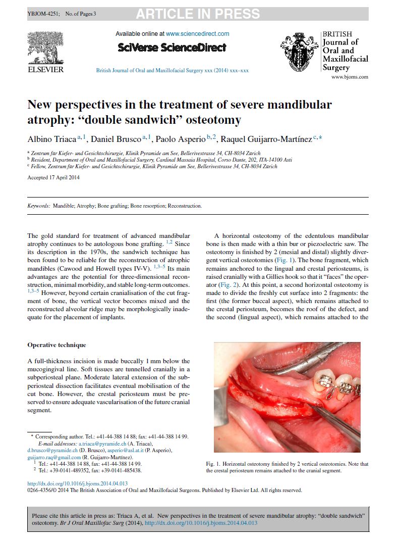 New perspectives in the treatment of severe mandibularatrophy: “double sandwich” osteotomy