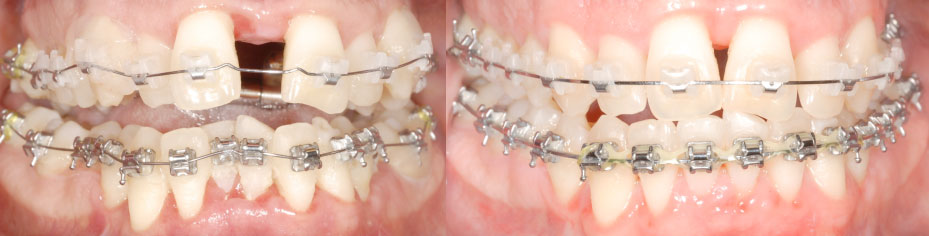 Zahnstellung vorher, Zahnstellung nach vier Monaten