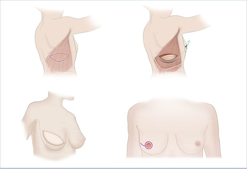 Breast reconstruction with back muscle