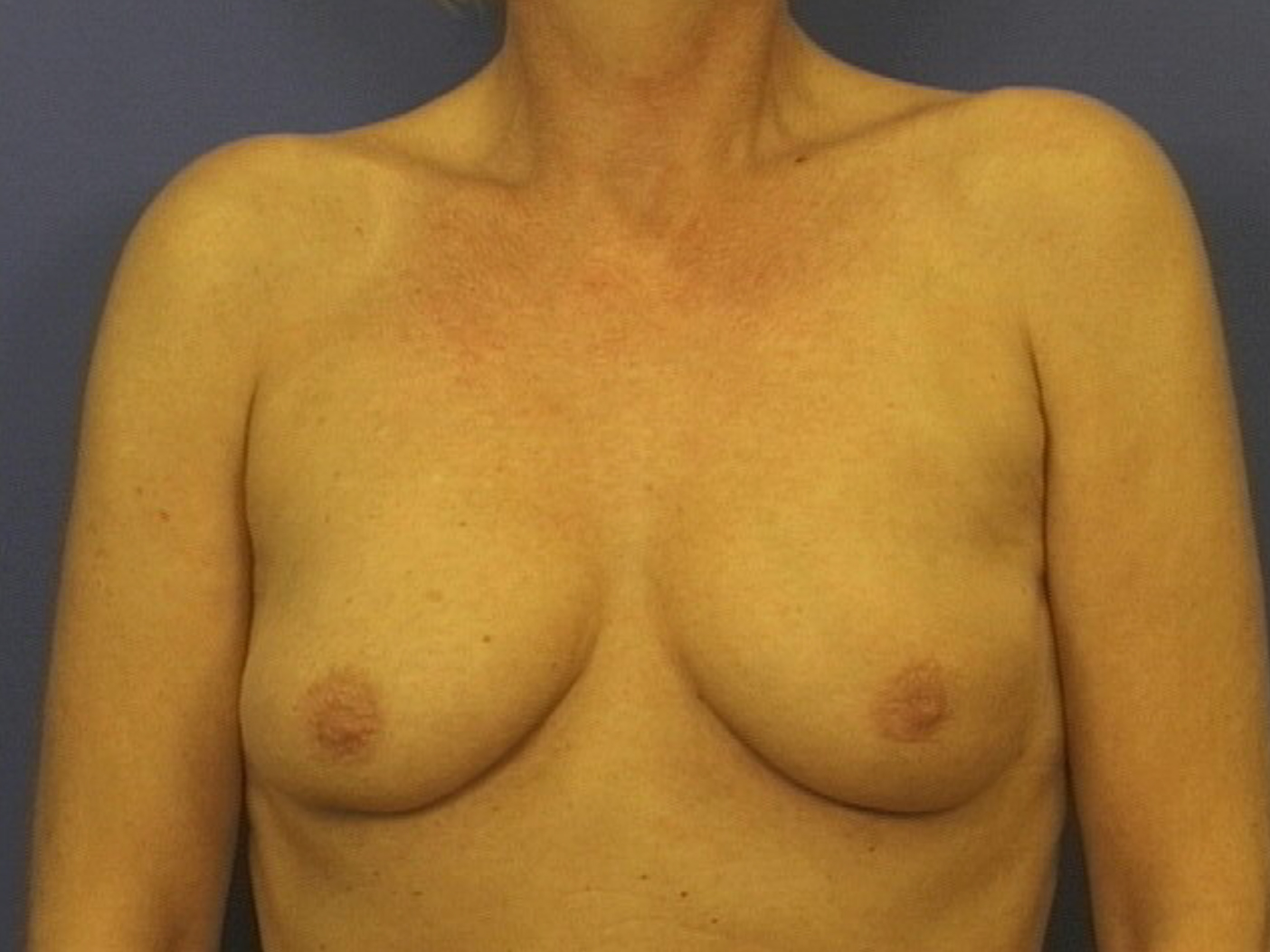 Breast-conserving surgery and radiotherapy