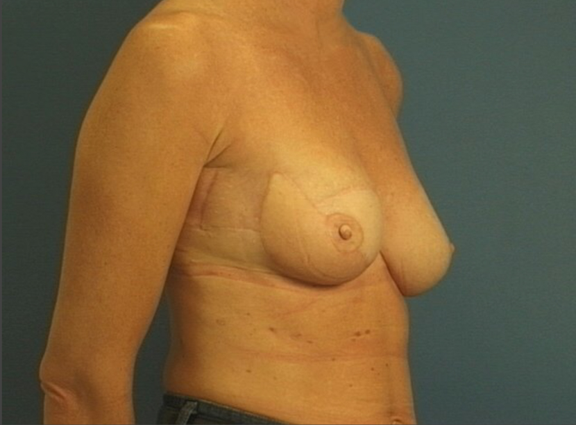 Subsequent reconstruction with latissimus dorsi (tissue from the back) and implant