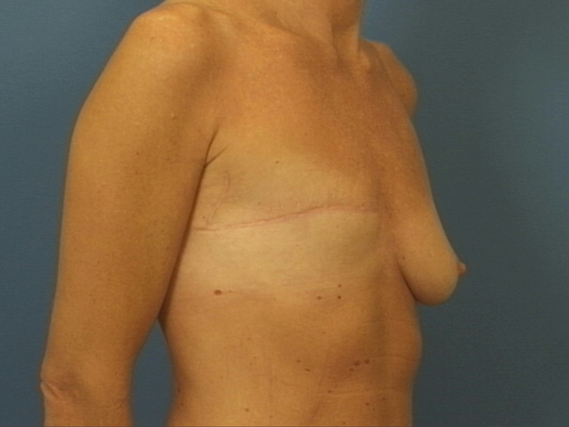 Subsequent reconstruction with latissimus dorsi (tissue from the back) and implant