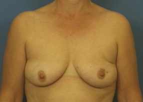 Skin-sparing mastectomy and immediate reconstruction with DIEP - before
