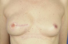 Skin-sparing mastectomy and immediate reconstruction with TMG - before