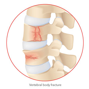 Vertebral body fracture