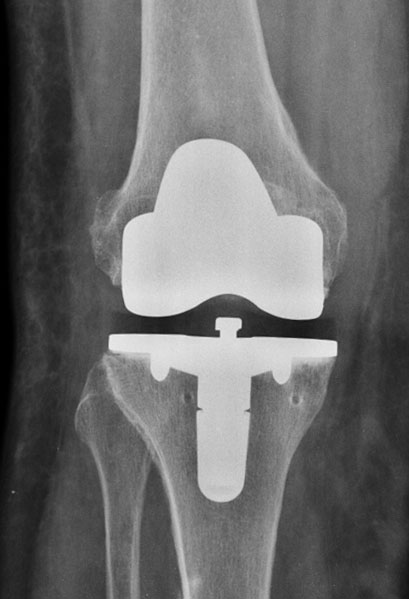Künstliches Kniegelenk: Was ist wichtiger der Chirurg oder das Prothesenmodell?