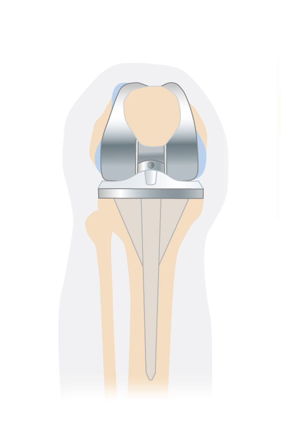 Revision Ihrer bestehenden Knieprothese | Klinik Pyramide